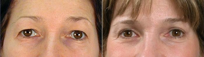 Eyelid Lift Case 875 Before & After View #4 | Paramus, New Jersey | Parker Center for Plastic Surgery