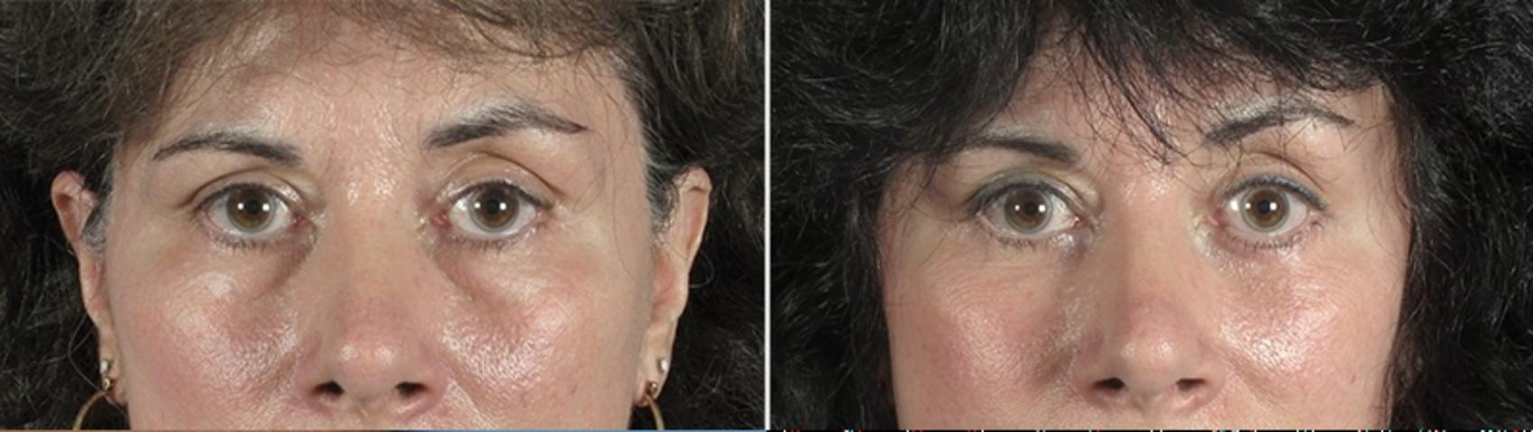 Eyelid Lift Case 876 Before & After View #4 | Paramus, New Jersey | Parker Center for Plastic Surgery