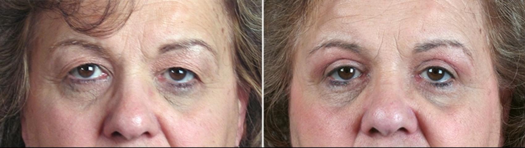 Eyelid Lift Case 877 Before & After View #4 | Paramus, New Jersey | Parker Center for Plastic Surgery