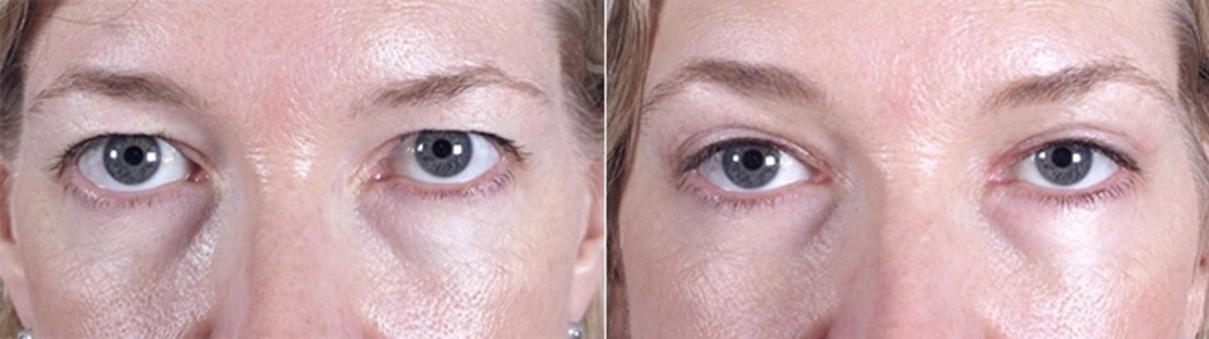 Eyelid Lift Case 879 Before & After View #4 | Paramus, New Jersey | Parker Center for Plastic Surgery