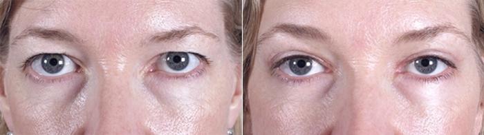 Eyelid Lift Case 879 Before & After View #4 | Paramus, New Jersey | Parker Center for Plastic Surgery