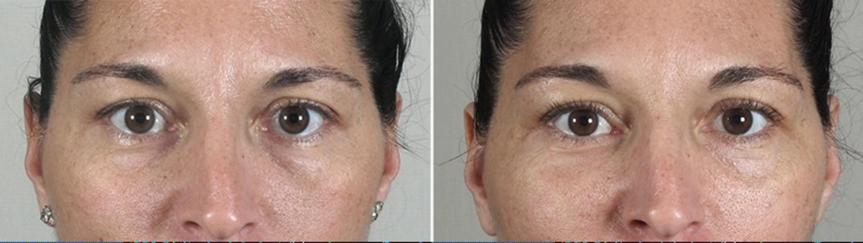 Eyelid Lift Case 882 Before & After View #4 | Paramus, New Jersey | Parker Center for Plastic Surgery