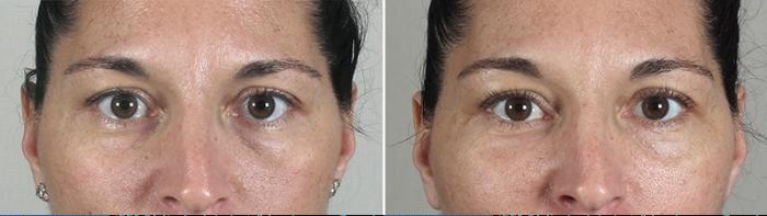 Eyelid Lift Case 882 Before & After View #4 | Paramus, New Jersey | Parker Center for Plastic Surgery