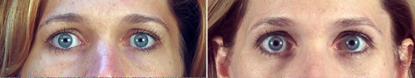 Eyelid Lift Case 886 Before & After View #4 | Paramus, New Jersey | Parker Center for Plastic Surgery
