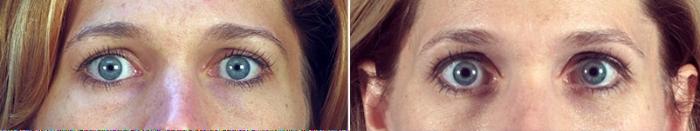 Eyelid Lift Case 886 Before & After View #4 | Paramus, New Jersey | Parker Center for Plastic Surgery