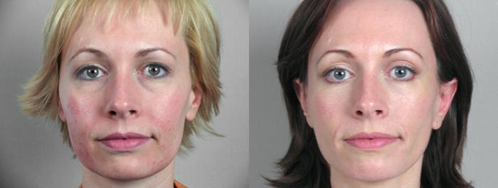 Eyelid Lift Case 9 Before & After View #1 | Paramus, New Jersey | Parker Center for Plastic Surgery