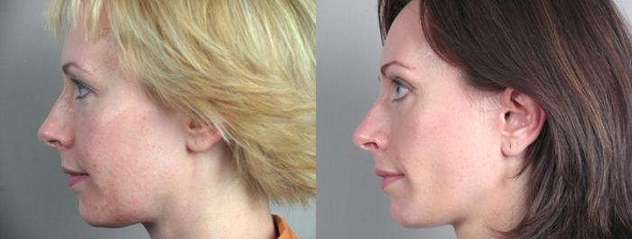 Eyelid Lift Case 9 Before & After View #2 | Paramus, New Jersey | Parker Center for Plastic Surgery