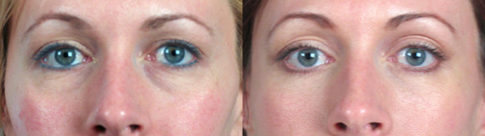 Eyelid Lift Case 9 Before & After View #3 | Paramus, New Jersey | Parker Center for Plastic Surgery