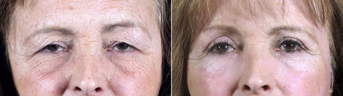 Nonsurgical Face Procedures Case 90 Before & After View #1 | Paramus, New Jersey | Parker Center for Plastic Surgery