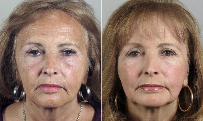 Eyelid Lift Case 90 Before & After View #2 | Paramus, New Jersey | Parker Center for Plastic Surgery