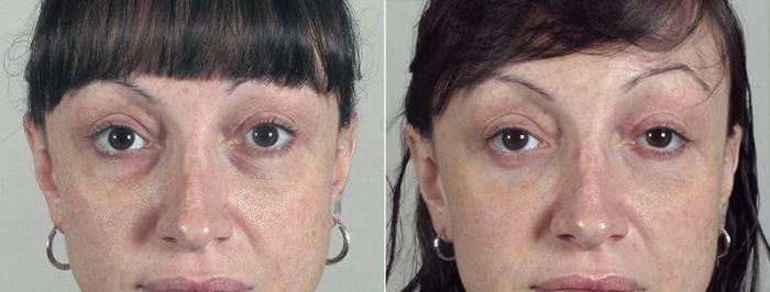 Eyelid Lift Case 92 Before & After View #2 | Paramus, New Jersey | Parker Center for Plastic Surgery