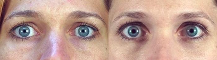 Eyelid Lift Case 93 Before & After View #1 | Paramus, New Jersey | Parker Center for Plastic Surgery