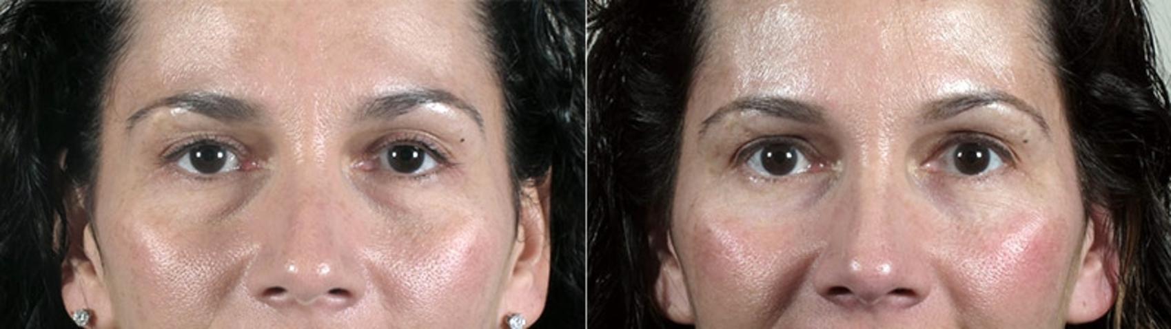 Eyelid Lift Case 94 Before & After View #1 | Paramus, New Jersey | Parker Center for Plastic Surgery