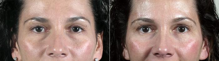 Eyelid Lift Case 94 Before & After View #1 | Paramus, New Jersey | Parker Center for Plastic Surgery