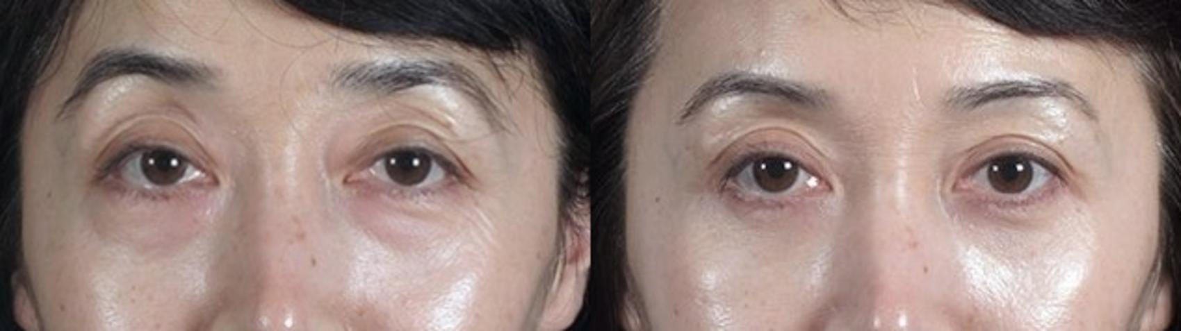 Eyelid Lift Case 97 Before & After View #1 | Paramus, New Jersey | Parker Center for Plastic Surgery