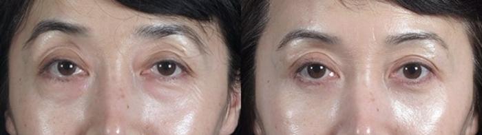 Eyelid Lift Case 97 Before & After View #1 | Paramus, New Jersey | Parker Center for Plastic Surgery