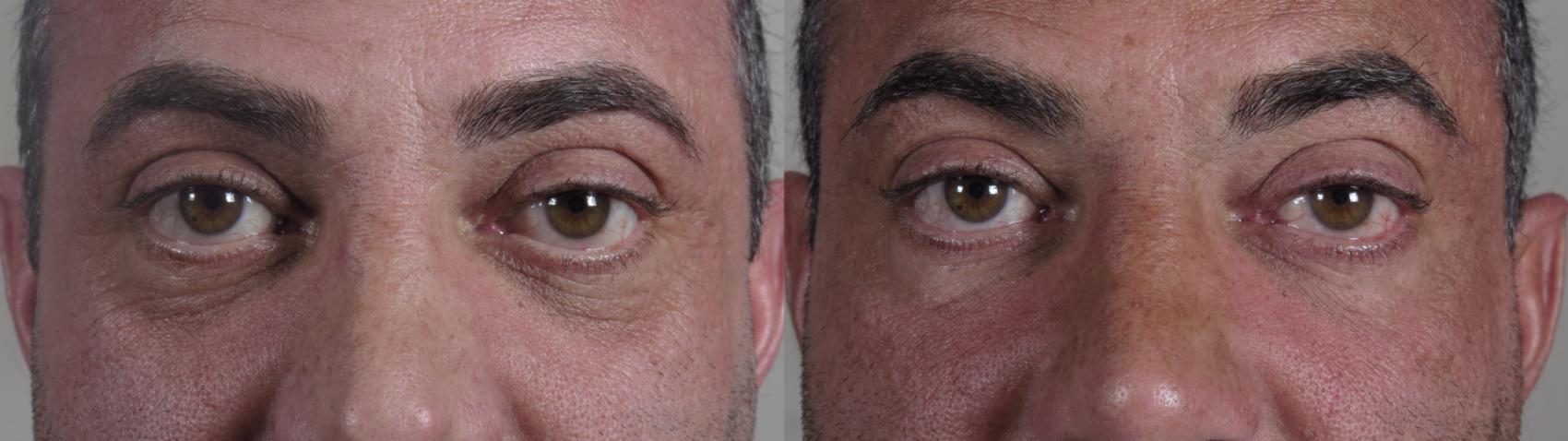 Eyelid Surgery Case 1015 Before & After Close up eyes | Paramus, New Jersey | Parker Center for Plastic Surgery