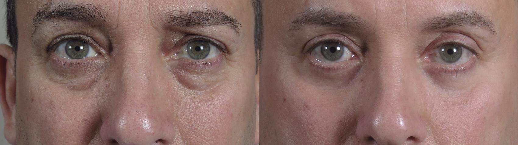 Eyelid Surgery Case 1017 Before & After front eye close up | Paramus, New Jersey | Parker Center for Plastic Surgery