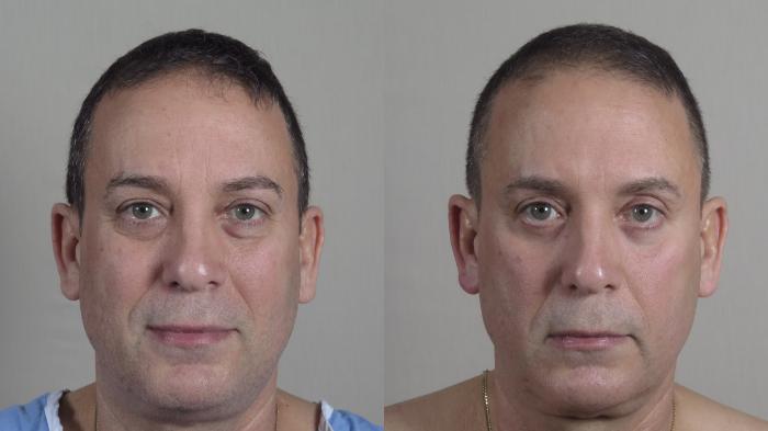 Eyelid Surgery Case 1017 Before & After Front | Paramus, New Jersey | Parker Center for Plastic Surgery