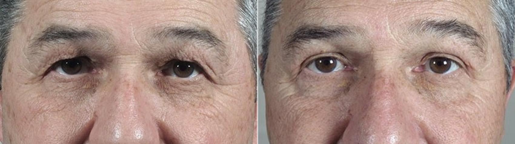 Eyelid Surgery Case 112 Before & After View #1 | Paramus, New Jersey | Parker Center for Plastic Surgery
