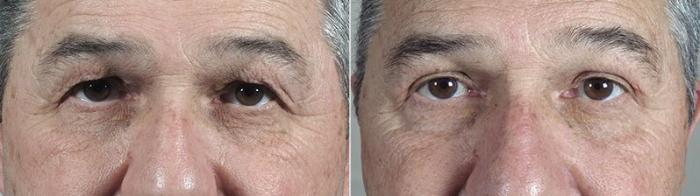 Eyelid Surgery Case 112 Before & After View #1 | Paramus, New Jersey | Parker Center for Plastic Surgery