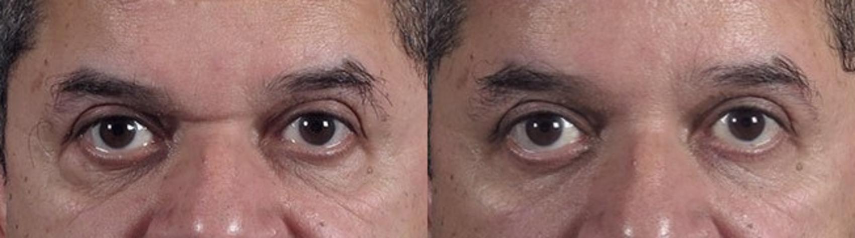 Eyelid Surgery Case 114 Before & After View #1 | Paramus, New Jersey | Parker Center for Plastic Surgery