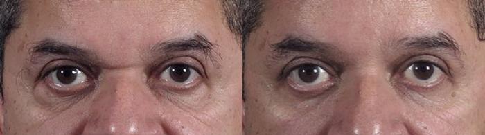 Eyelid Surgery Case 114 Before & After View #1 | Paramus, New Jersey | Parker Center for Plastic Surgery
