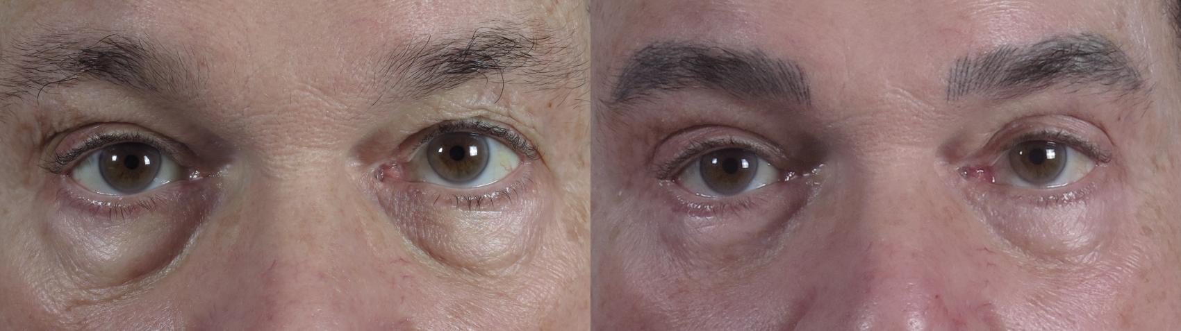 Eyelid Surgery Case 1326 Before & After Front | Paramus, New Jersey | Parker Center for Plastic Surgery