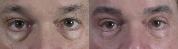 Eyelid Surgery Case 1326 Before & After Front | Paramus, New Jersey | Parker Center for Plastic Surgery