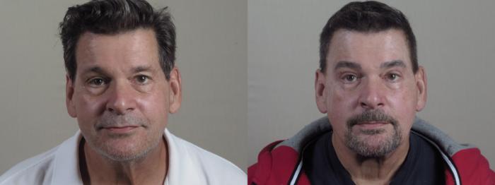 Eyelid Surgery Case 1326 Before & After front view 2  | Paramus, New Jersey | Parker Center for Plastic Surgery