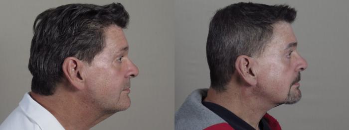 Eyelid Surgery Case 1326 Before & After Left Side | Paramus, New Jersey | Parker Center for Plastic Surgery