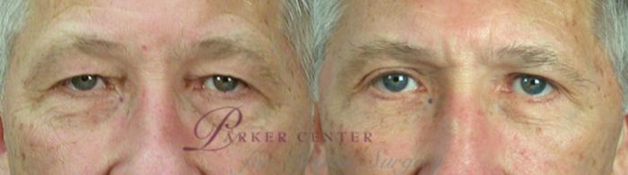 Eyelid Surgery Case 1383 Before & After Front | Paramus, New Jersey | Parker Center for Plastic Surgery