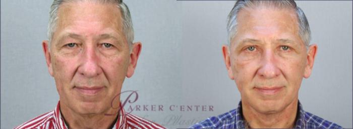 Eyelid Surgery Case 1383 Before & After View front  | Paramus, New Jersey | Parker Center for Plastic Surgery