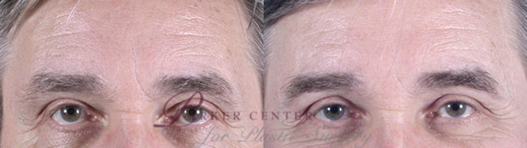 Eyelid Surgery Case 1384 Before & After Front | Paramus, New Jersey | Parker Center for Plastic Surgery