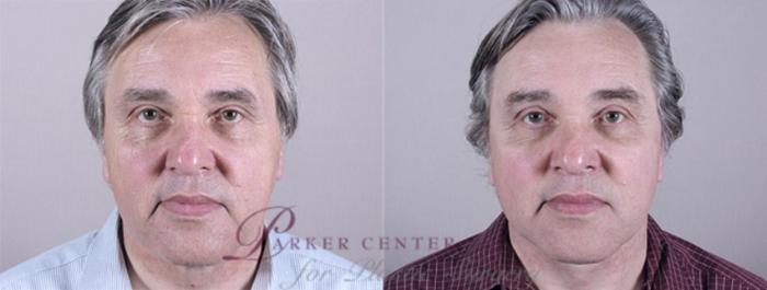 Eyelid Surgery Case 1384 Before & After View front  | Paramus, New Jersey | Parker Center for Plastic Surgery