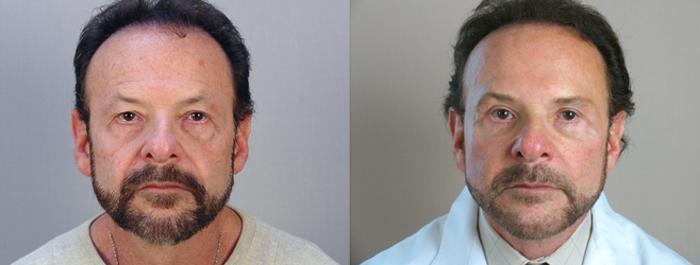 Eyelid Surgery Case 14 Before & After View #1 | Paramus, New Jersey | Parker Center for Plastic Surgery