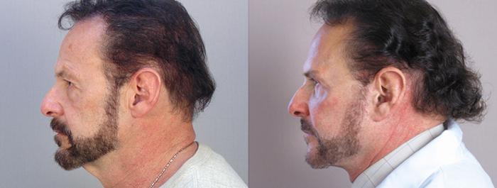 Eyelid Surgery Case 14 Before & After View #2 | Paramus, New Jersey | Parker Center for Plastic Surgery