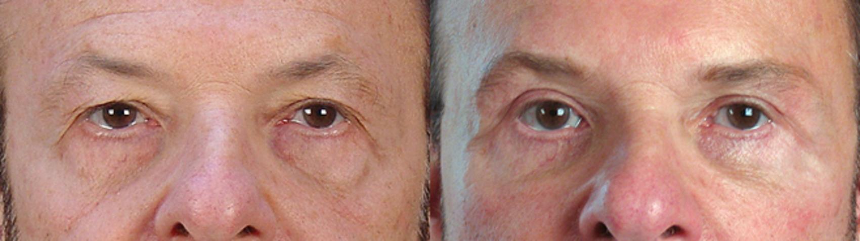 Eyelid Surgery Case 14 Before & After View #3 | Paramus, New Jersey | Parker Center for Plastic Surgery