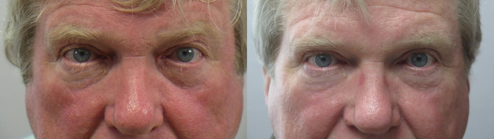 Eyelid Surgery Case 1646 Before & After Front | Paramus, New Jersey | Parker Center for Plastic Surgery