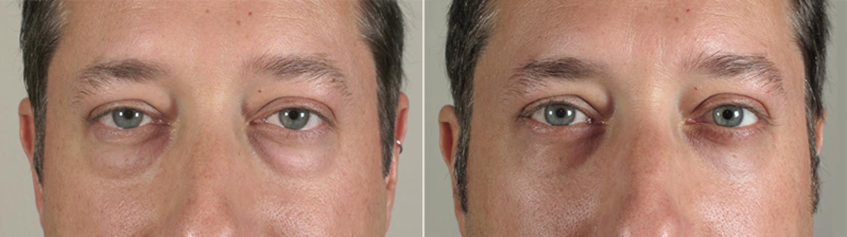 Eyelid Surgery Case 48 Before & After View #1 | Paramus, New Jersey | Parker Center for Plastic Surgery