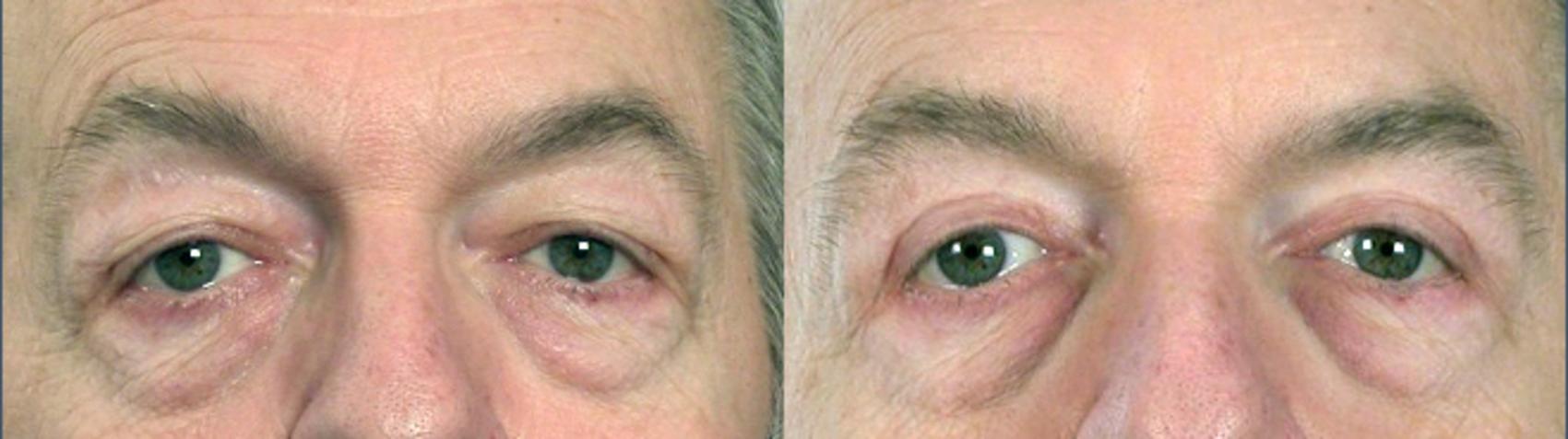 Eyelid Surgery Case 49 Before & After View #1 | Paramus, New Jersey | Parker Center for Plastic Surgery