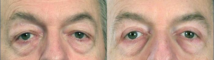 Eyelid Surgery Case 49 Before & After View #1 | Paramus, New Jersey | Parker Center for Plastic Surgery
