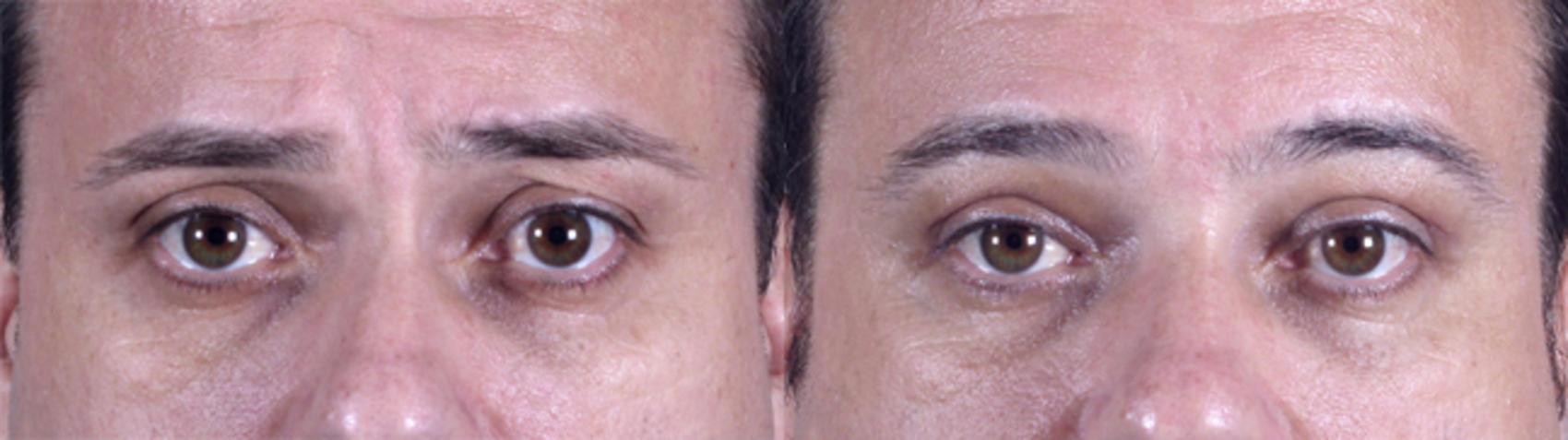 Eyelid Surgery Case 50 Before & After View #1 | Paramus, New Jersey | Parker Center for Plastic Surgery