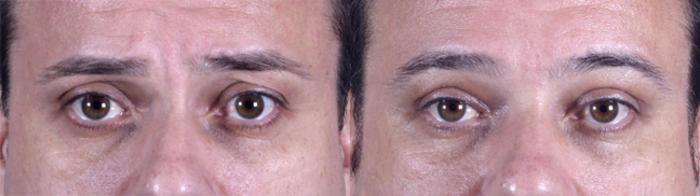 Eyelid Surgery Case 50 Before & After View #1 | Paramus, New Jersey | Parker Center for Plastic Surgery