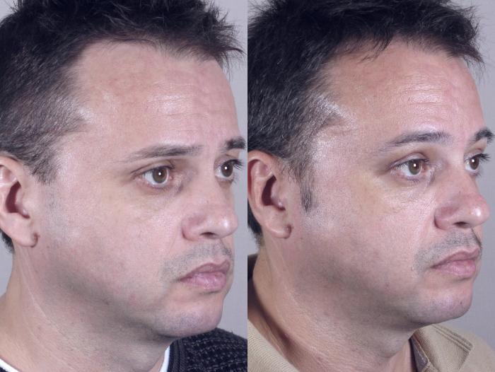 Eyelid Surgery Case 50 Before & After View #2 | Paramus, New Jersey | Parker Center for Plastic Surgery