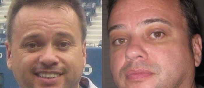 Eyelid Surgery Case 50 Before & After View #3 | Paramus, New Jersey | Parker Center for Plastic Surgery