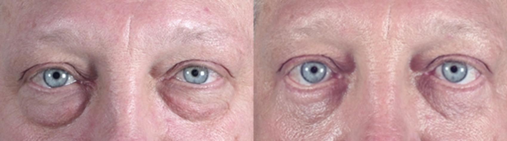 Eyelid Surgery Case 51 Before & After View #1 | Paramus, New Jersey | Parker Center for Plastic Surgery