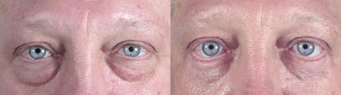 Eyelid Surgery Case 51 Before & After View #1 | Paramus, New Jersey | Parker Center for Plastic Surgery