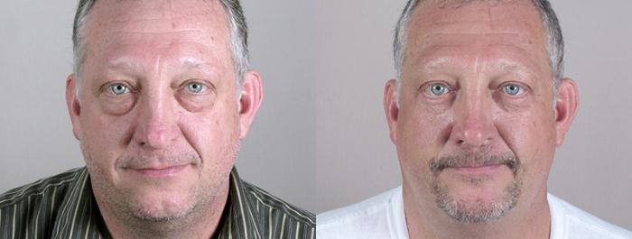 Eyelid Surgery Case 51 Before & After View #2 | Paramus, New Jersey | Parker Center for Plastic Surgery