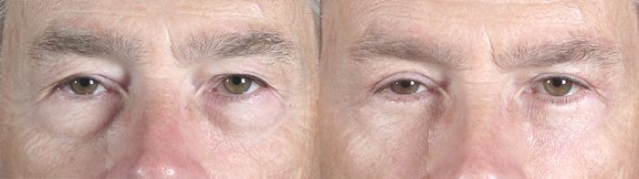 Eyelid Surgery Case 52 Before & After View #1 | Paramus, New Jersey | Parker Center for Plastic Surgery